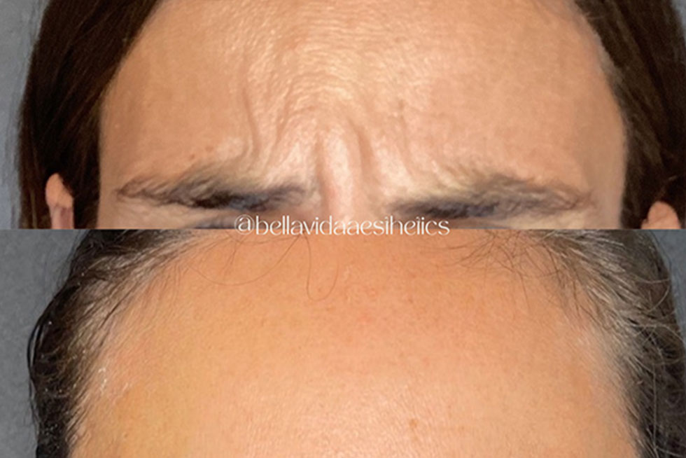 Before and after neurotoxin treatment at Bella Vida